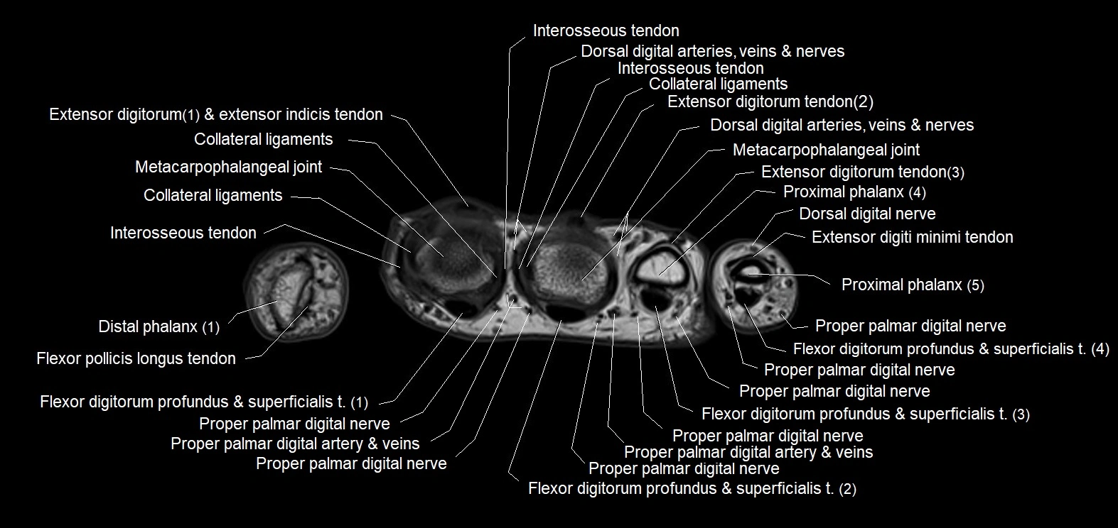 MRI 3T  hand axial labelled cross sectional anatomy imagemy  22.webp